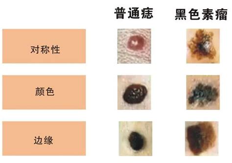 乳頭長痣|是痣還是瘤？黑色素瘤的類型、症狀與治療